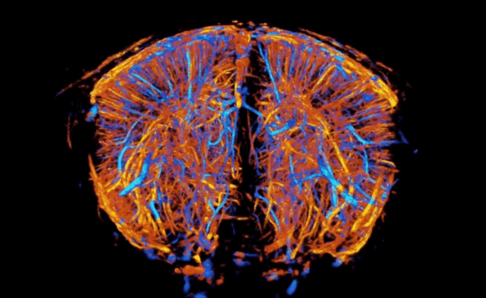 Unlocking the potential of true volumetric ULM angiography